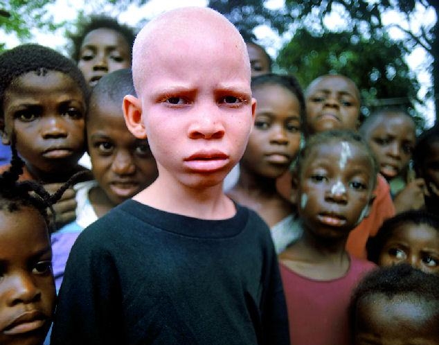 ребенок альбинос в Африке изгой